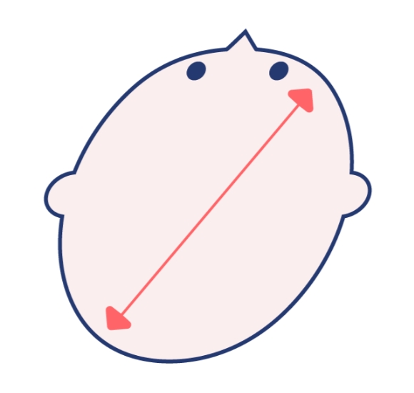 斜頭症