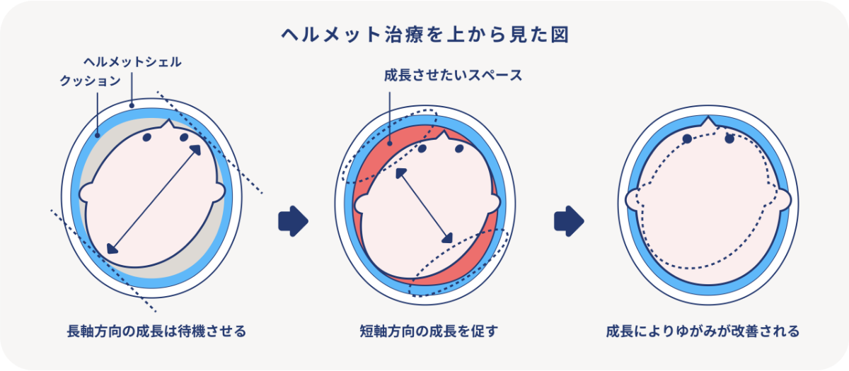 ヘルメット治療とは